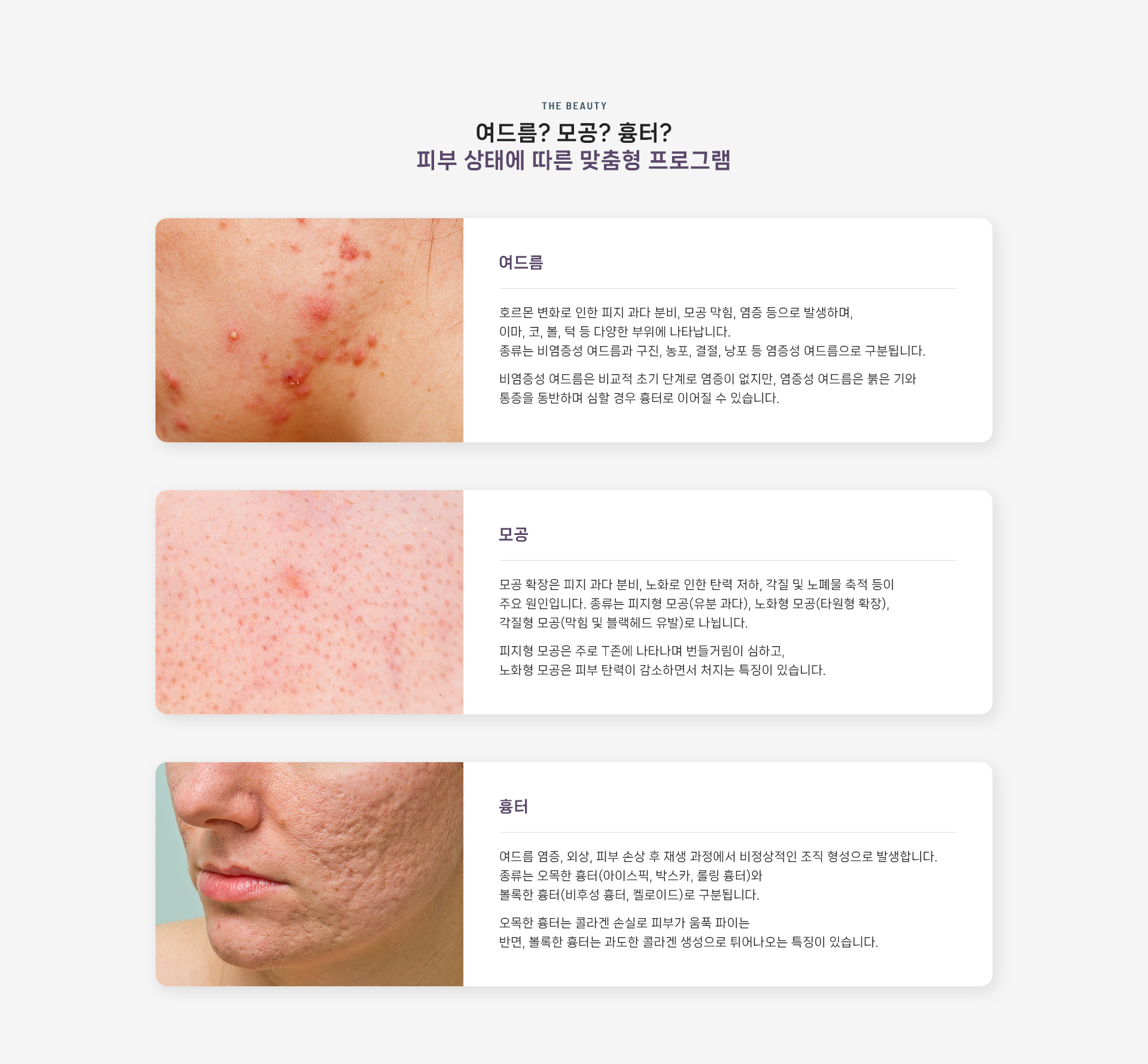 여드름/모공/흉터 상세03
