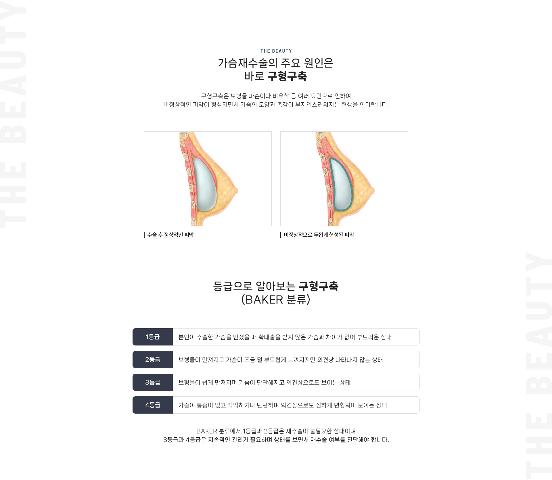 가슴재수술 상세04