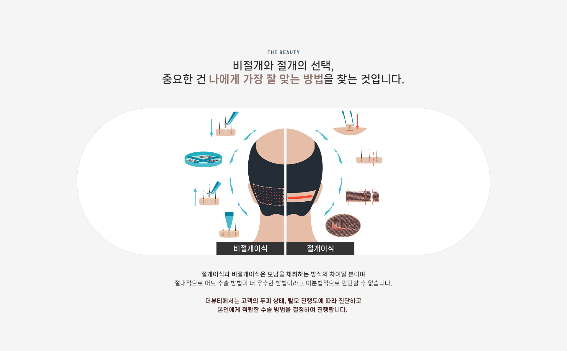 비절개이식 상세03