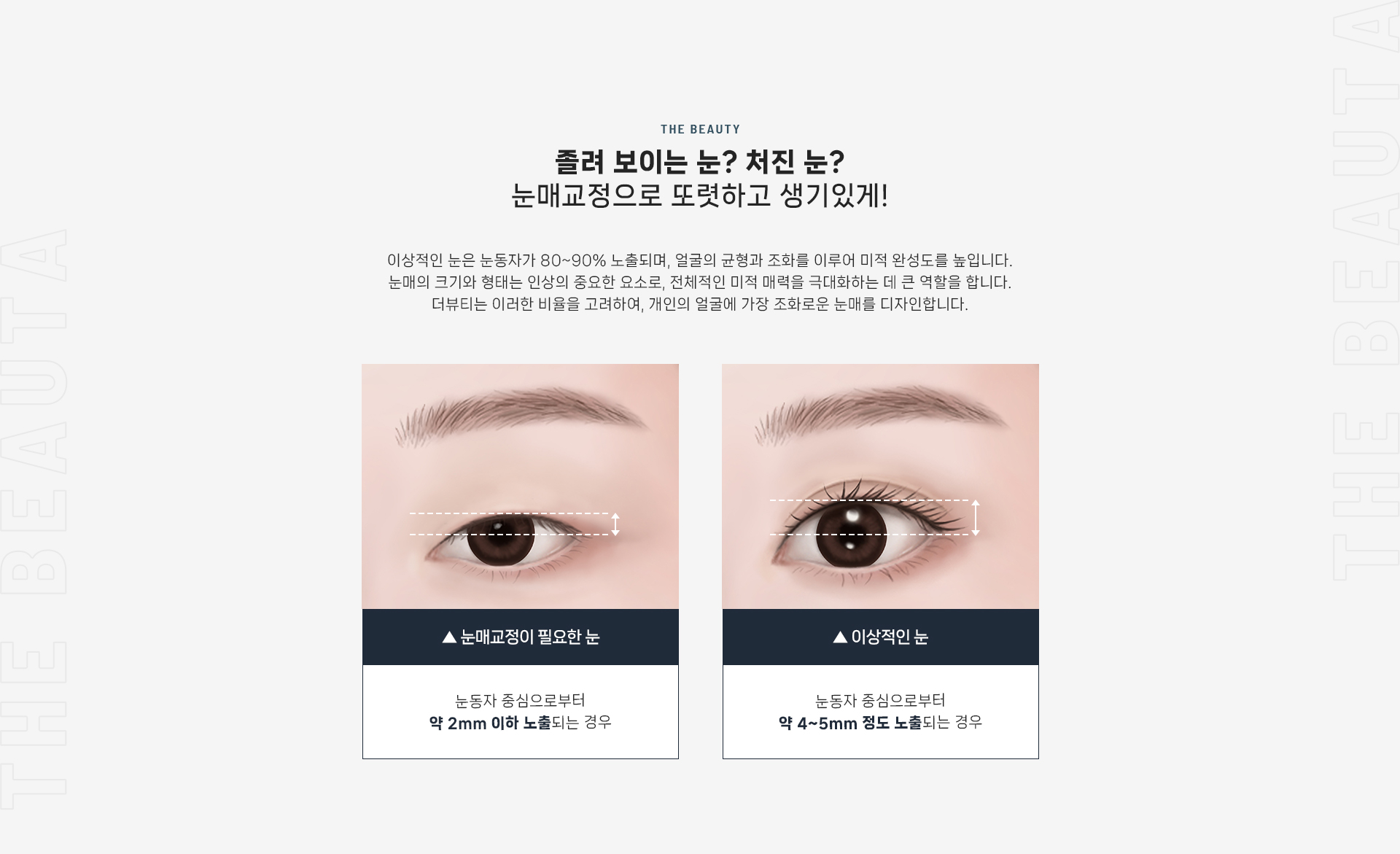 눈매교정 상세03