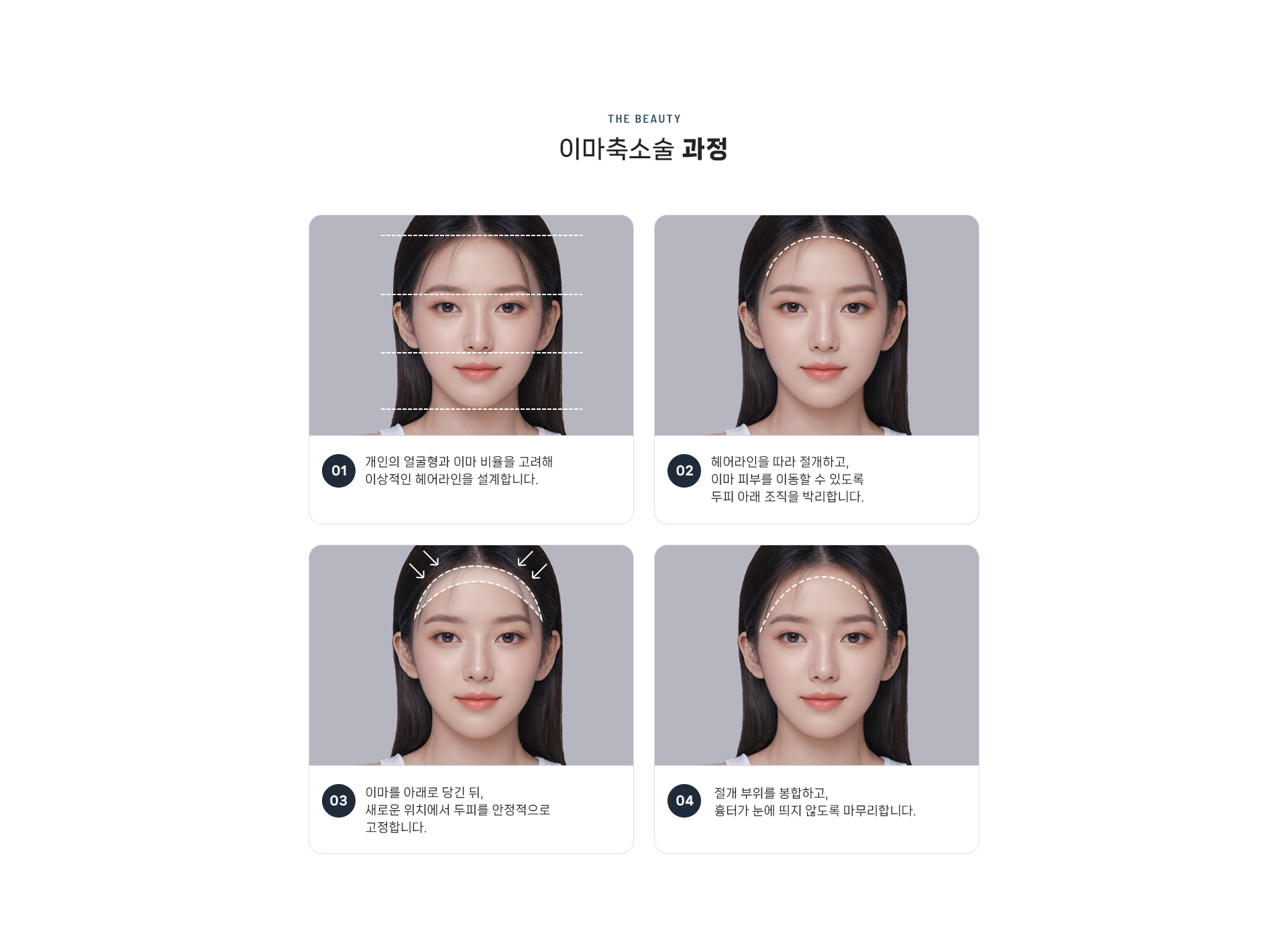이마축소술 상세04