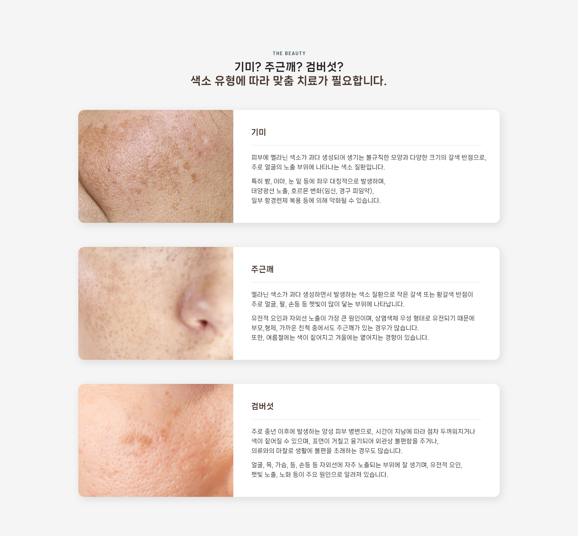 기미/주근깨/검버섯 상세03
