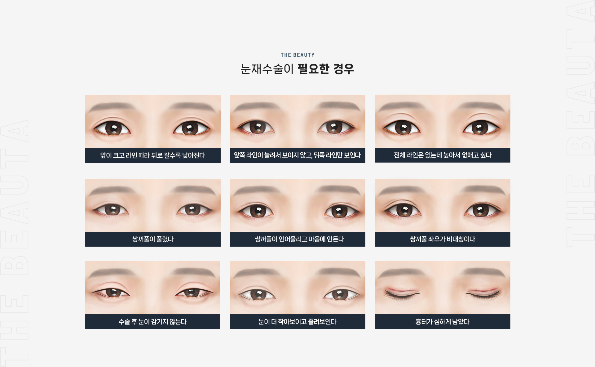 눈재수술 상세03