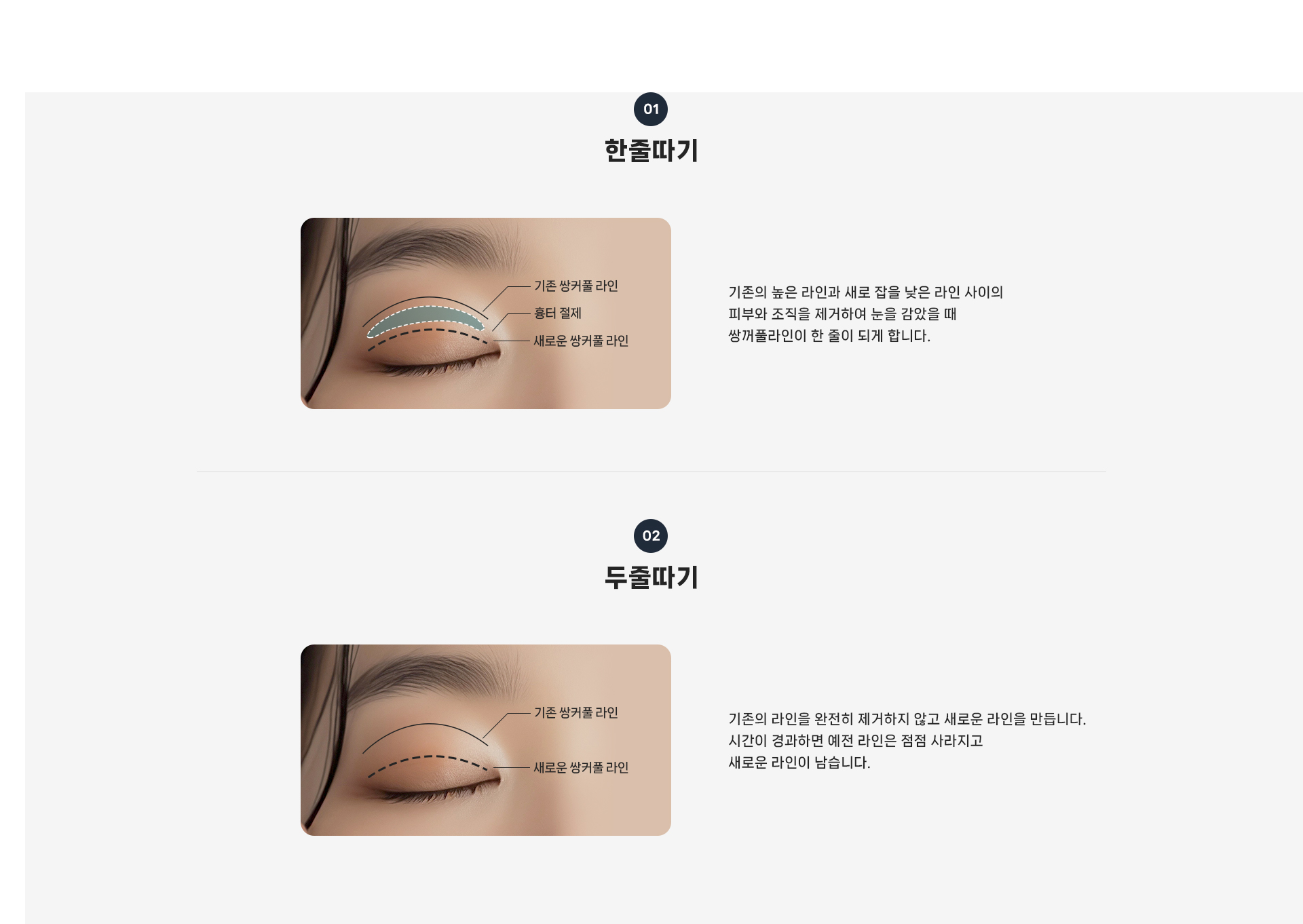 눈재수술 상세06