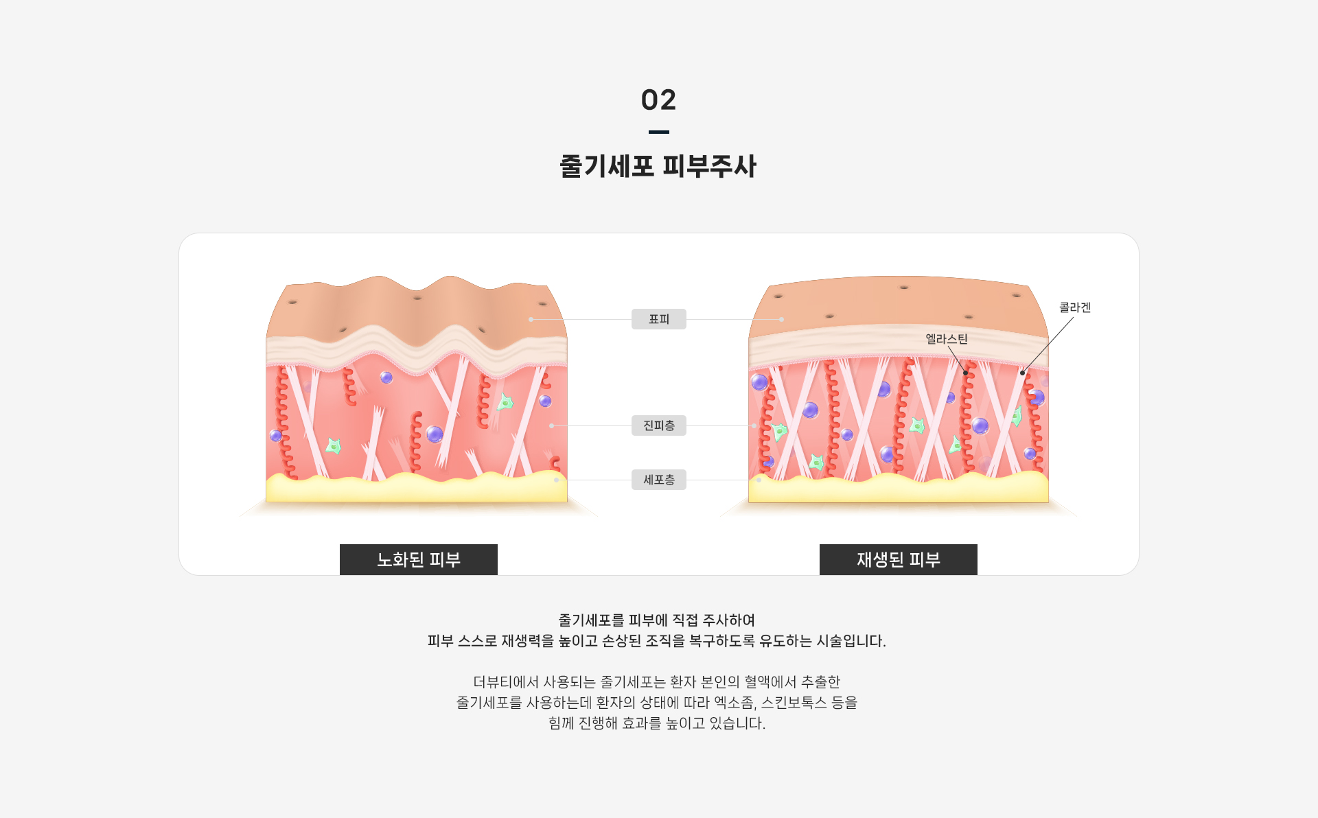줄기세포 셀테라피 상세07