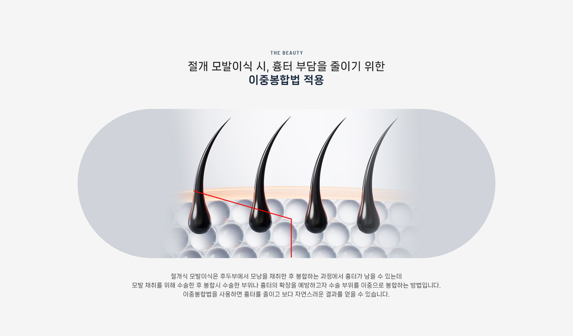 절개이식 상세03