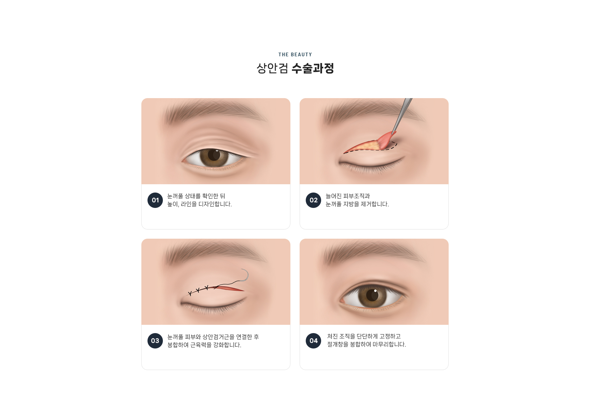 상안검 상세06
